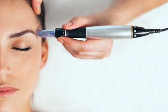 microneedling estimula tu piel desde el interior